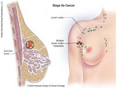 breast11.jpg