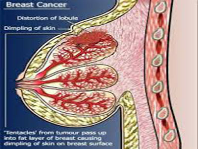 breast15.jpg