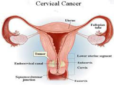 cervical11.jpg