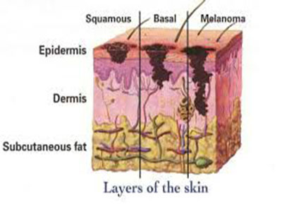 melanoma11.jpg
