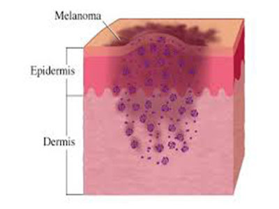 melanoma12.jpg
