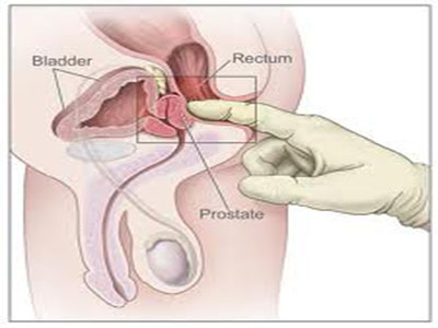 prostate11.jpg