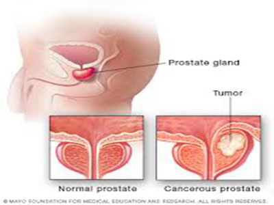 prostate12.jpg