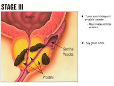 prostate13.jpg